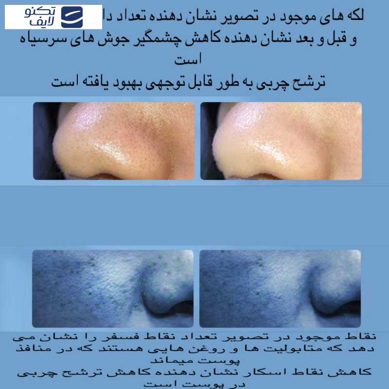 میکرودرم خانگی مدل Super Micro Bubble میکرودرم خانگی مدل Super Micro Bubble