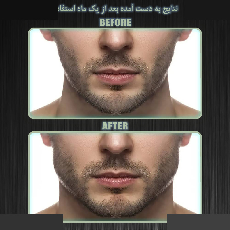 زاویه ساز فک رادیس فیت مدل Full Weight بسته شش عددی زاویه ساز فک رادیس فیت مدل Full Weight بسته شش عددی