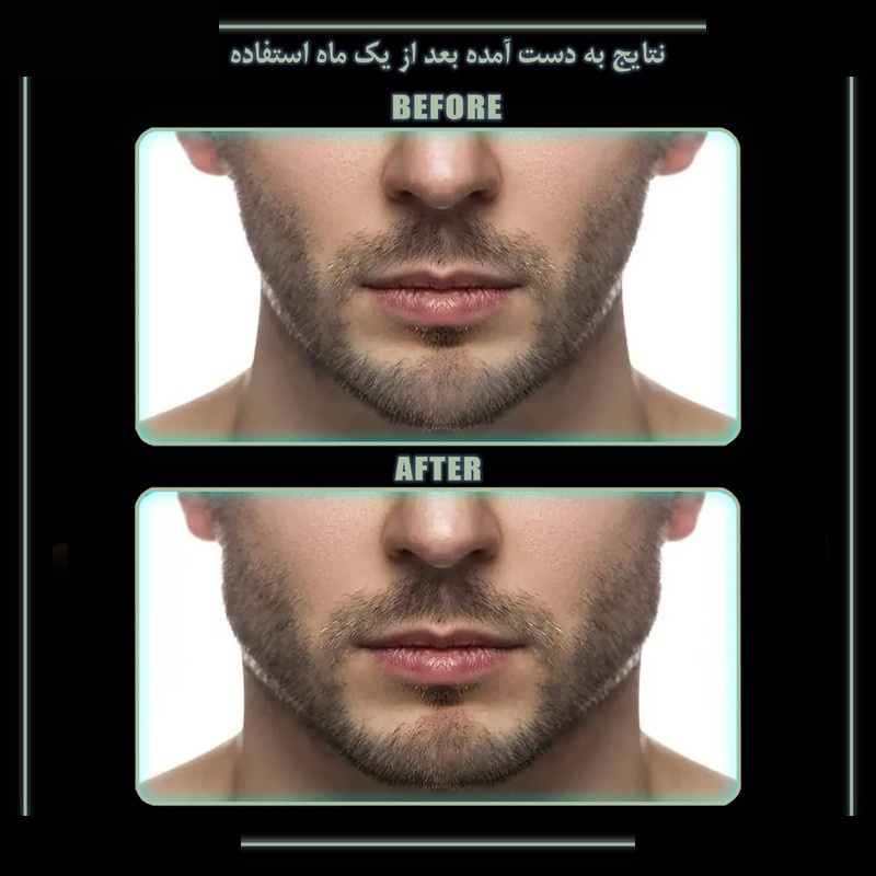دستگاه زاویه ساز فک رادیس فیت مدل 3Levels 3W بسته 6 عددی دستگاه زاویه ساز فک رادیس فیت مدل 3Levels 3W بسته 6 عددی