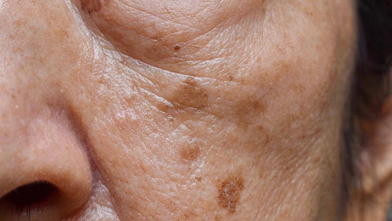 افزایش سن یکی از دلایل ایجاد لکه های قهوه ای روی پوست صورت