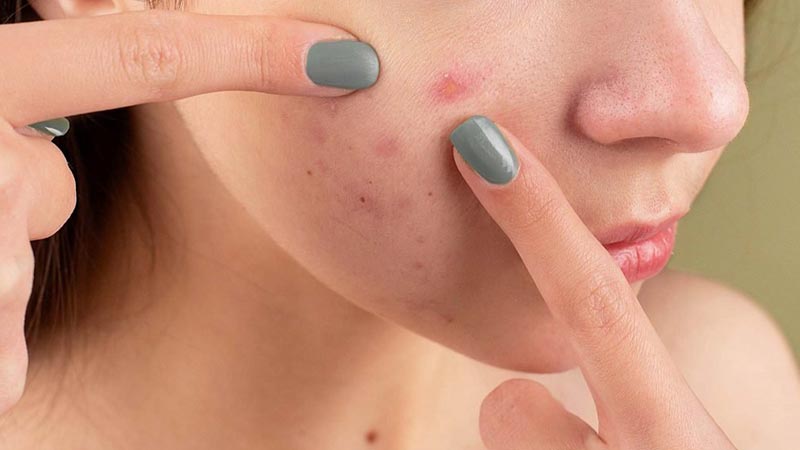 پرهیز از دستکاری جوش و زخم‌های پوستی