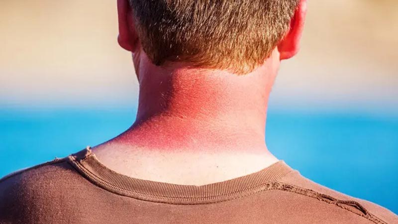 دلایل ایجاد لکه های قهوه ای صورت