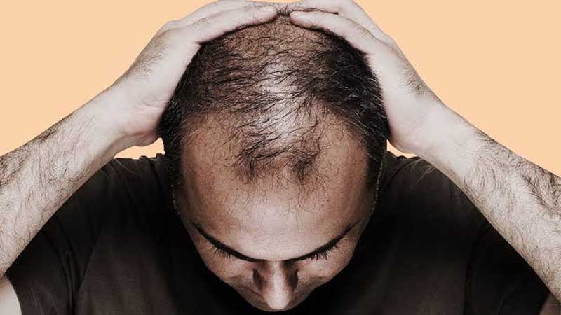 علت ریزش مو در مردان